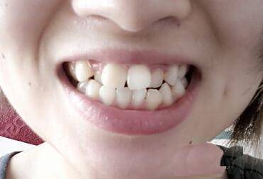 下牙齿有缝隙的人面相_牙齿面相学_牙齿有缝隙的人面相